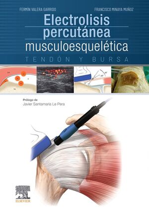 ELECTROLISIS PERCUTÁNEA MUSCULOESQUELÉTICA