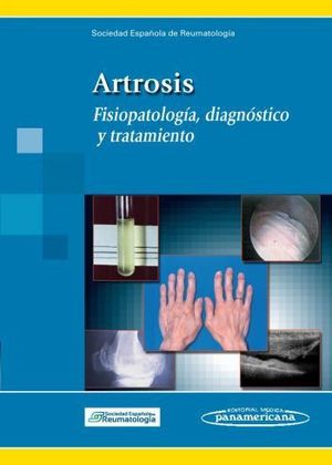 ARTROSIS, FISIOPATOLOGÍA, DIAGNÓSTICO Y TRATAMIENTO