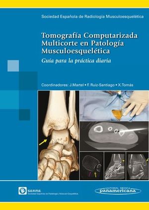TOMOGRAFIA COMPUTERIZADA MULTICORTE EN PATOLOGÍA MUSCULOESQUELÉTICA